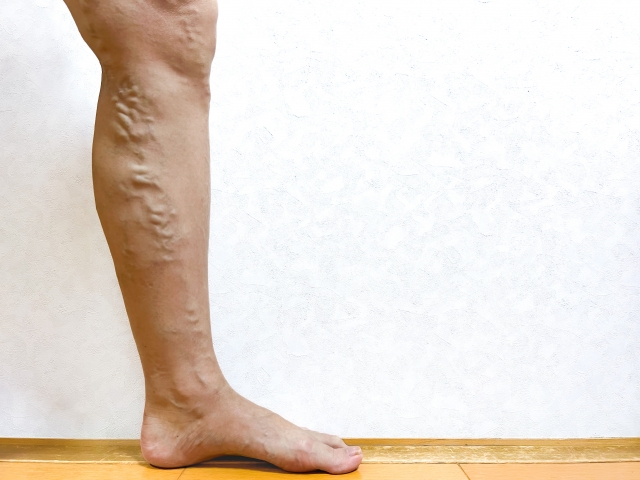 日帰り下肢静脈瘤手術について