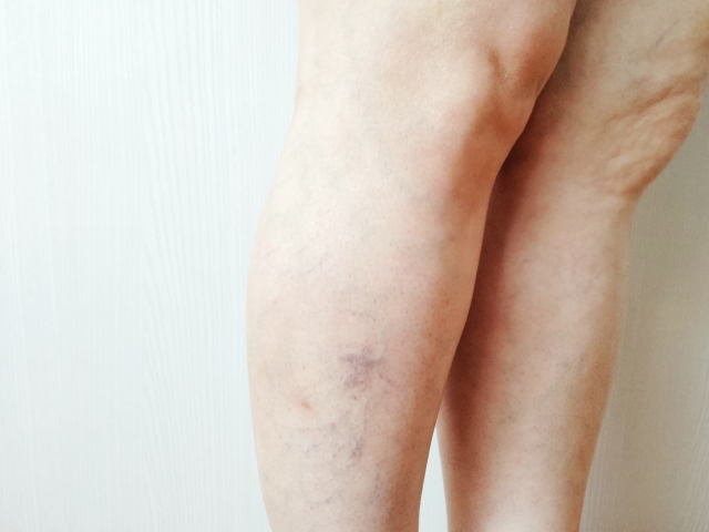 足の血管が浮き出る・目立つ